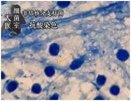 杭州瘦腿打女子针后皮肤溃烂险排查,截肢数月减肥药千之瘦图片