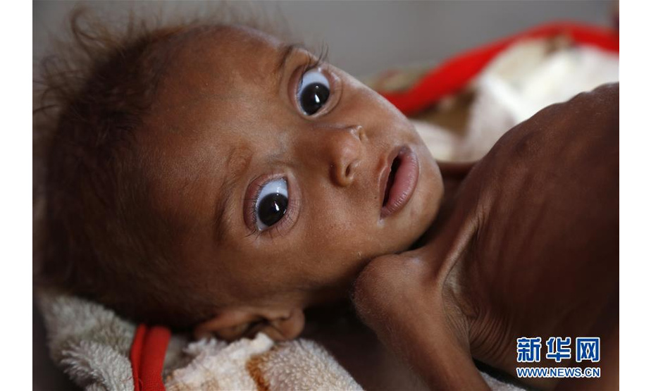 10月17日，在也门首都萨那一家医院，一名营养不良的儿童在接受治疗。

　　10月17日是国际消除贫困日，联合国将今年的主题确定为“共同行动，实现儿童家庭社区赋权，消除贫困”。 新华社发（穆罕默德摄）