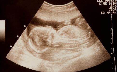 孩子出生有3条腿 产检6次没检查出来